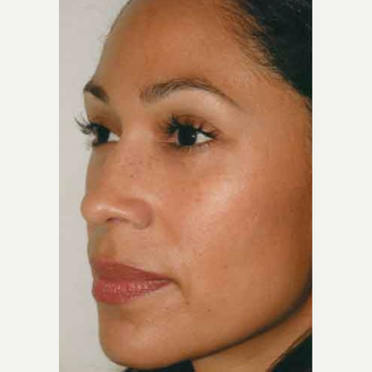 35-44 year old woman treated with Rhinoplasty after 3406180