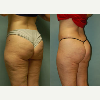 49 year-old woman 7 months post Cellulaze and Smartlipo of buttocks, posterior and lateral thighs after 3262013