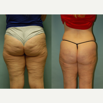 49 year-old woman 7 months post Cellulaze and Smartlipo of buttocks, posterior and lateral thighs before 3262013
