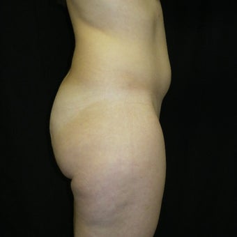 25-34 year old woman treated with Butt Augmentation 1536081