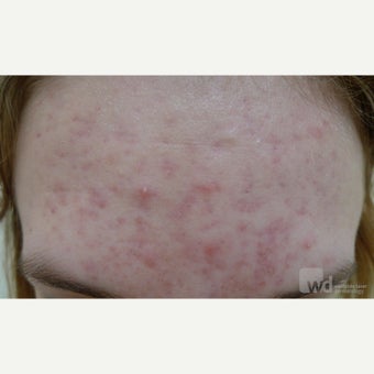 Acne and scars treated with eMatrix before 1764357