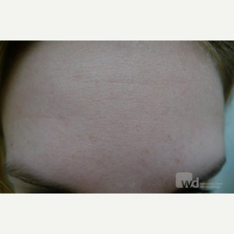 Acne and scars treated with eMatrix after 1764357