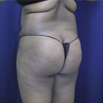 35-44 year old woman treated with Brazilian Butt Lift before 3305189