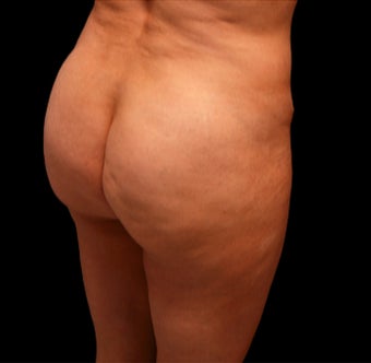 35-44 year old woman treated with Cellfina before 3220653