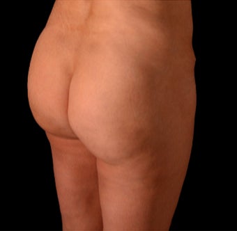 35-44 year old woman treated with Cellfina after 3220653