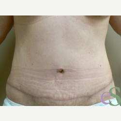44 year old woman treated with Tummy Tuck after 3484886