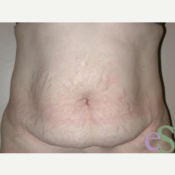 44 year old woman treated with Tummy Tuck before 3484886