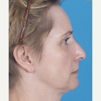 45-54 year old woman treated with Rhinoplasty after 3159574
