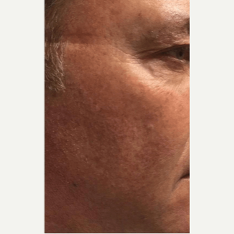 45-54 year old man treated with Microneedling after 2894126