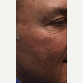 45-54 year old man treated with Microneedling before 2894126