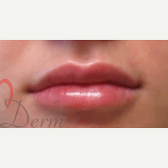 25-34 year old woman treated with Lip Augmentation after 3216866