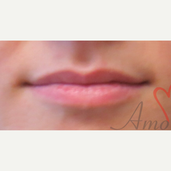 25-34 year old woman treated with Lip Augmentation before 3216866