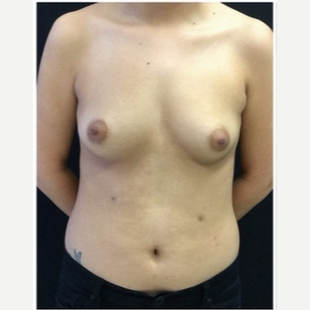 18-24 year old woman treated with Breast Implants before 3103492
