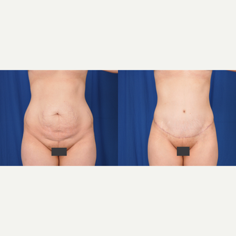 25-34 year old woman treated with Tummy Tuck before 3590378