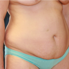 32 year old woman treated with Tummy Tuck before 3202980