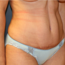 32 year old woman treated with Tummy Tuck after 3202980