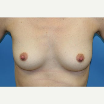 25-34 year old woman treated with Gel Breast Implants before 1944742