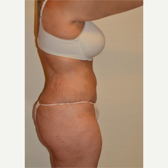 25-34 year old woman treated with Tummy Tuck after 3658513