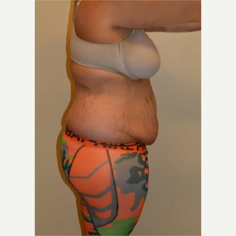 25-34 year old woman treated with Tummy Tuck before 3658513
