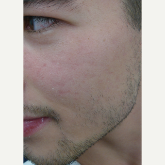 Picosure FOCUS for early acne scars- exception rather than the rule. after 3590684