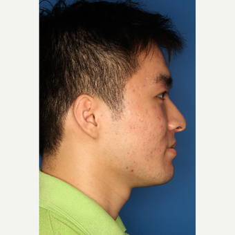 25-34 year old man treated with Acne Treatment after 3709898
