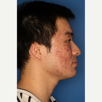 25-34 year old man treated with Acne Treatment before 3709898