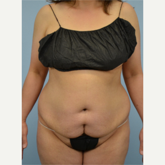 46 year old woman treated with Tummy Tuck before 3432224