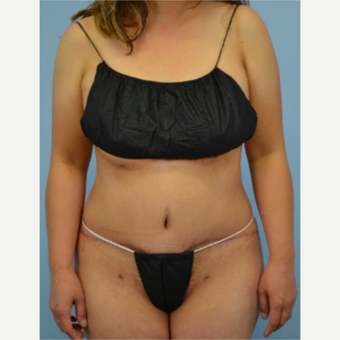 46 year old woman treated with Tummy Tuck after 3432224