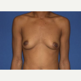 25-34 year old woman treated with Breast Augmentation before 3220019