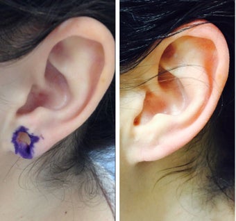 25-34 year old woman treated with Ear Lobe Surgery before 2697653