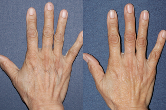 Sclerotherapy For Hand Veins before 967962