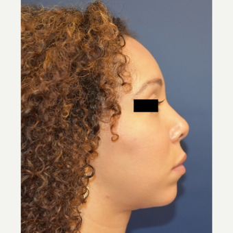 25-34 year old woman treated with Nose Surgery after 3496706