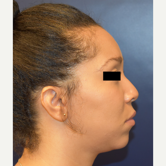 25-34 year old woman treated with Nose Surgery before 3496706
