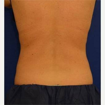 35-44 year old woman treated with CoolSculpting after 1756284