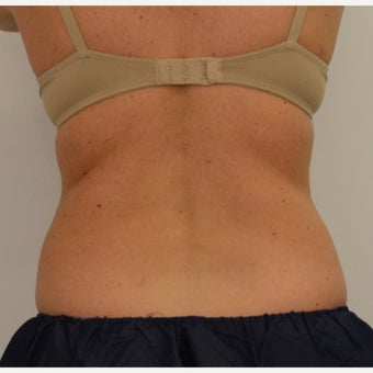 35-44 year old woman treated with CoolSculpting before 1756284
