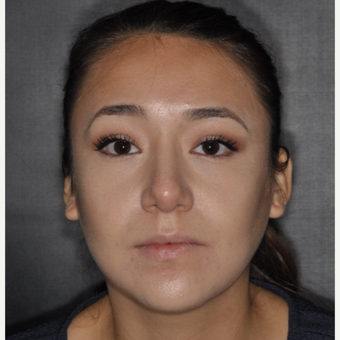 18-24 year old woman treated with Septoplasty 1 year post-op after 3708695