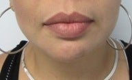 Chin Implant after 3141706