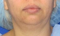 Chin Implant before 3141706