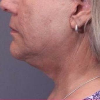 65-74 year old woman treated with Facelift after 3758452