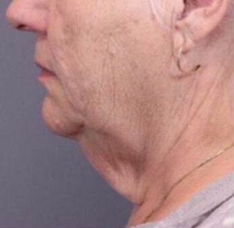 65-74 year old woman treated with Facelift before 3758452