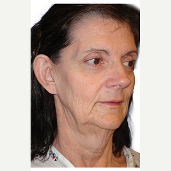 42 year old woman treated with Neck Lift before 3548835