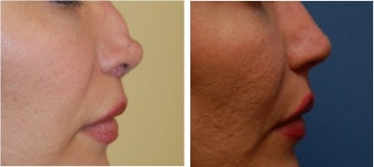 Revision Rhinoplasty before 334250