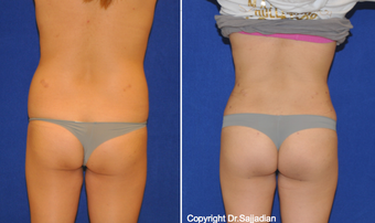 Butt Augmentation before 1262615