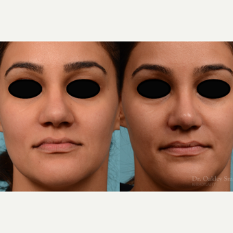 25-34 year old woman treated with Rhinoplasty before 3821213