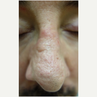 55-64 year old man treated with Dermabrasion before 3139453