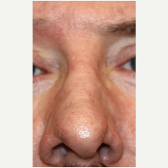 55-64 year old man treated with Dermabrasion after 3139453