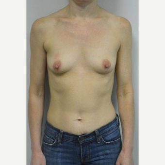 45-54 year old woman treated with Breast Implants who wants a natural look before 3604022