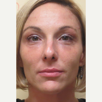 25-34 year old woman treated with Botox after 3504950
