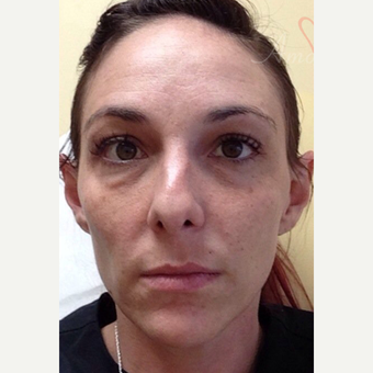 25-34 year old woman treated with Botox before 3504950
