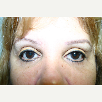 52 year old woman treated with Eyelid Surgery after 3442580